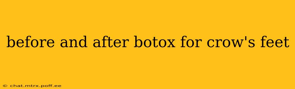 before and after botox for crow's feet