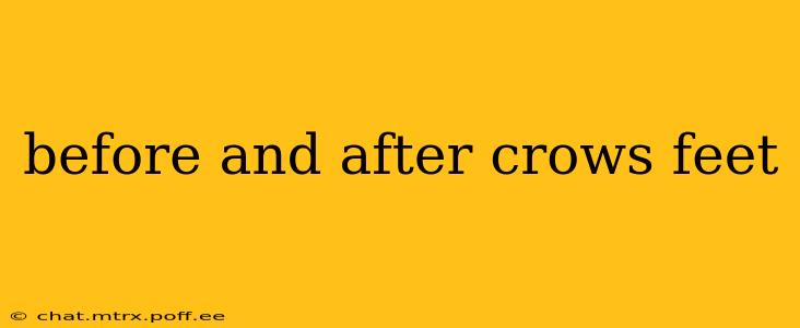 before and after crows feet