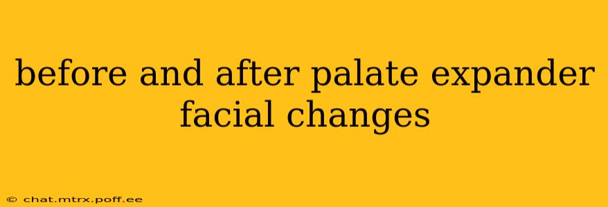 before and after palate expander facial changes