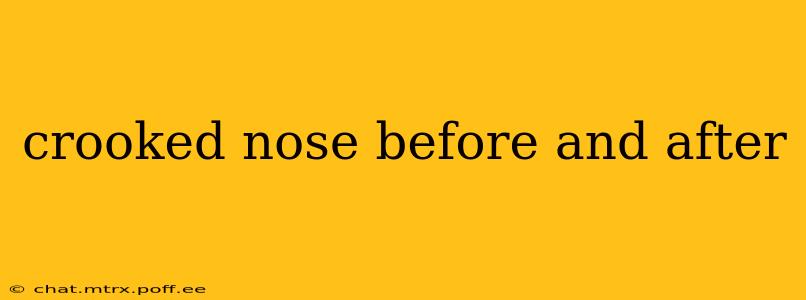 crooked nose before and after