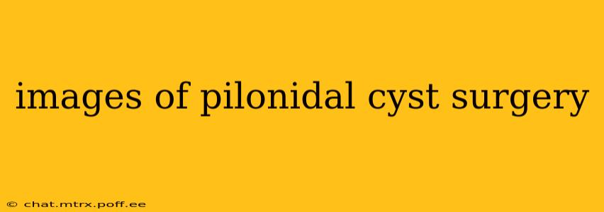 images of pilonidal cyst surgery
