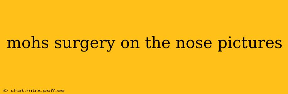 mohs surgery on the nose pictures