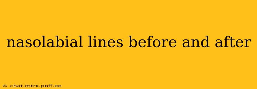 nasolabial lines before and after