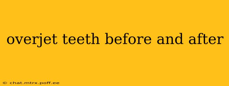 overjet teeth before and after