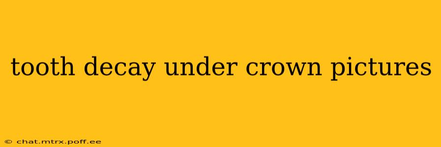 tooth decay under crown pictures