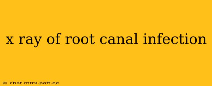 x ray of root canal infection